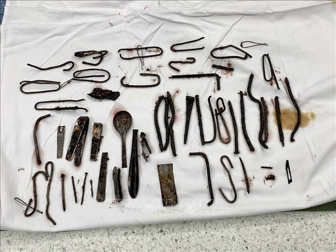 Bệnh viện Quân y 175 phẫu thuật, lấy ra khoảng 1 kg kim loại trong bụng một bệnh nhân