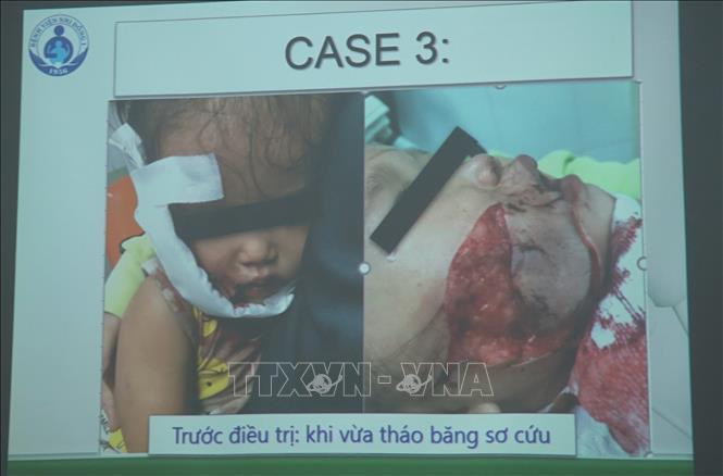 Thành phố Hồ Chí Minh: Cảnh báo tai nạn thương tích trẻ em do chó cắn