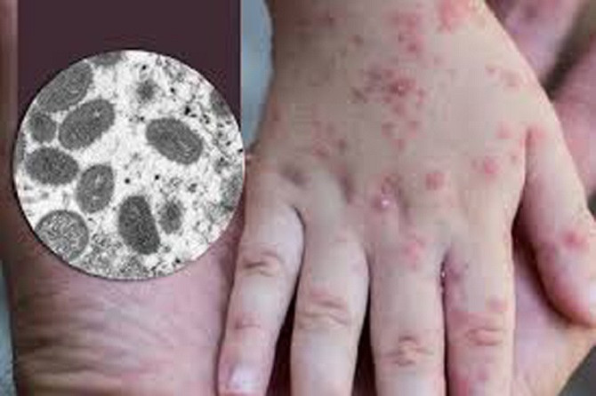 Bến Tre phát hiện ca bệnh đậu mùa khỉ đầu tiên