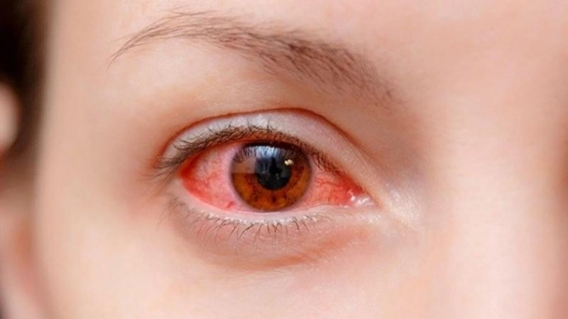 Đau mắt đỏ biến chứng có thể ảnh hưởng tới thị lực lâu dài của trẻ