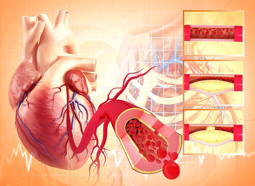 Đột biến gene tạo máu liên quan đến bệnh tim