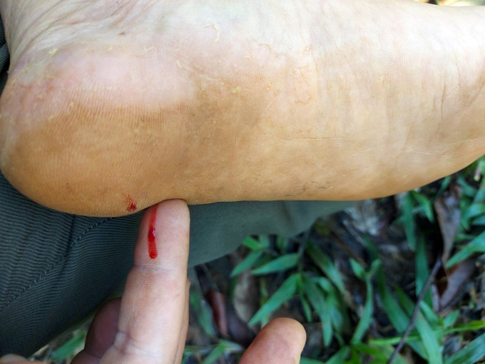 Một nhân viên quản lý bảo vệ rừng giẫm phải đinh và bị thương. Ảnh: TTXVN phát Đắk Nông: Điều tra vụ việc "lâm tặc" cài bẫy đinh, ngăn cản lực lượng quản lý, bảo vệ rừng ảnh 1