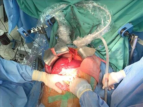 Bệnh viện Trung ương Huế lập kỷ lục thực hiện 21 ca ghép tạng trong vòng một tháng