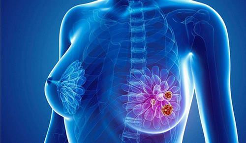 Loại thuốc mới giúp tăng cơ hội sống cho bệnh nhân ung thư vú