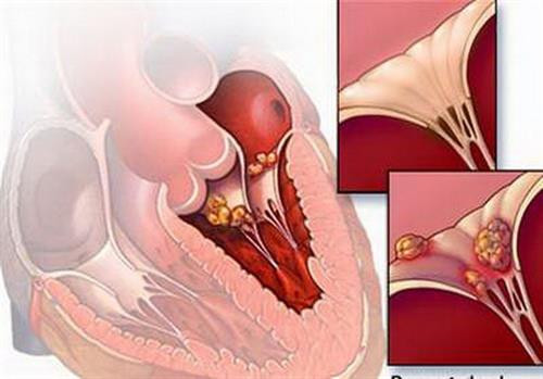 Viêm cơ tim vẫn có thể ngăn ngừa