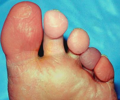 Raynaud - Chứng bệnh xuất hiện khi trời lạnh
