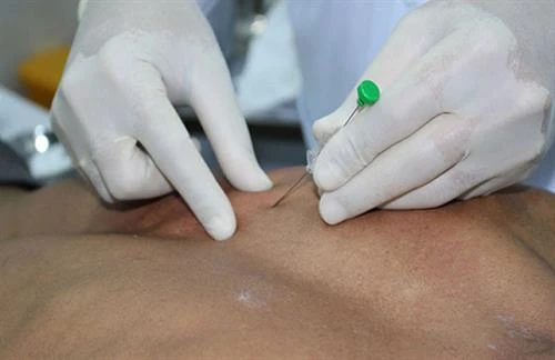 Thủy châm: Phương pháp điều trị kết hợp y học hiện đại và y học cổ truyền