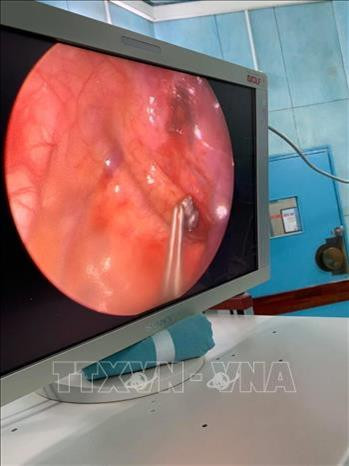 ​Phẫu thuật nội soi lấy viên đạn ra khỏi lồng ngực bé trai 6 tuổi