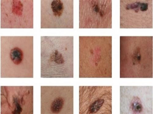 Phương pháp mới hứa hẹn điều trị hiệu quả ung thư hắc tố da