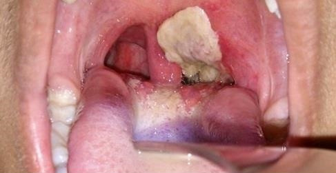Đắk Lắk: Ghi nhận một trường hợp tử vong nghi do bệnh bạch hầu