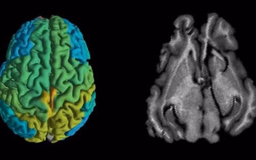 Kỹ thuật MRI mới giúp sớm phát hiện các căn bệnh thoái hóa thần kinh