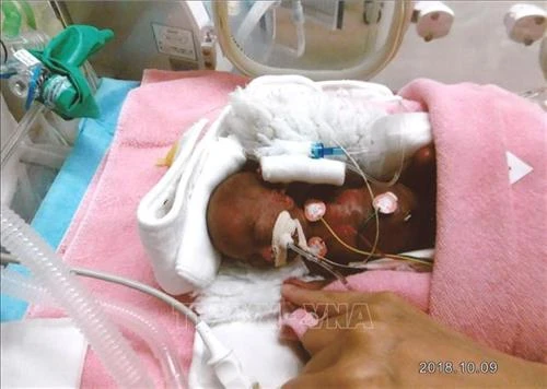 Hành trình đầu đời của cậu bé "tí hon" nhất thế giới