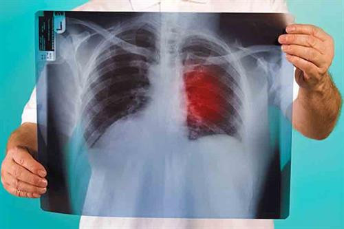 Israel phát triển phương pháp mới chữa trị ung thư