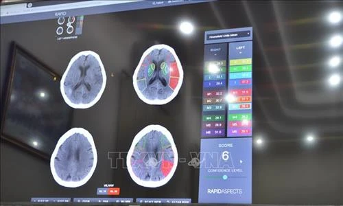 Ứng dụng trí tuệ nhân tạo trong chẩn đoán và điều trị đột quỵ