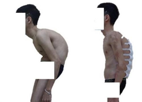 Nắn chỉnh biến dạng cột sống thành công cho bệnh nhân “siêu gù”