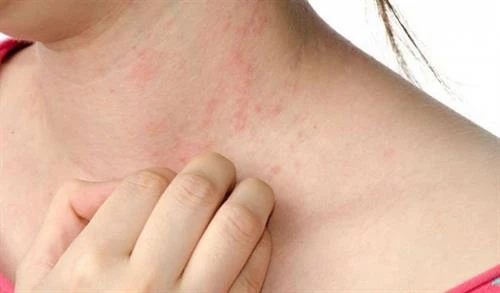 Nghiên cứu về phương pháp chữa trị bệnh phát ban đỏ