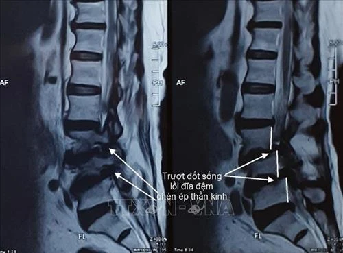 Cần Thơ: Bước tiến mới trong điều trị bệnh trượt đốt sống thắt lưng