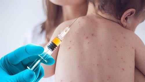 Thêm một phát hiện mới về tác hại của bệnh sởi
