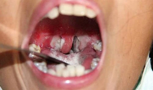 Đắk Lắk: Khẩn trương ứng phó với bệnh bạch hầu