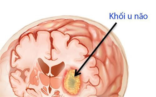 Israel phát triển phương pháp đột phá giúp điều trị ung thư não ác tính​