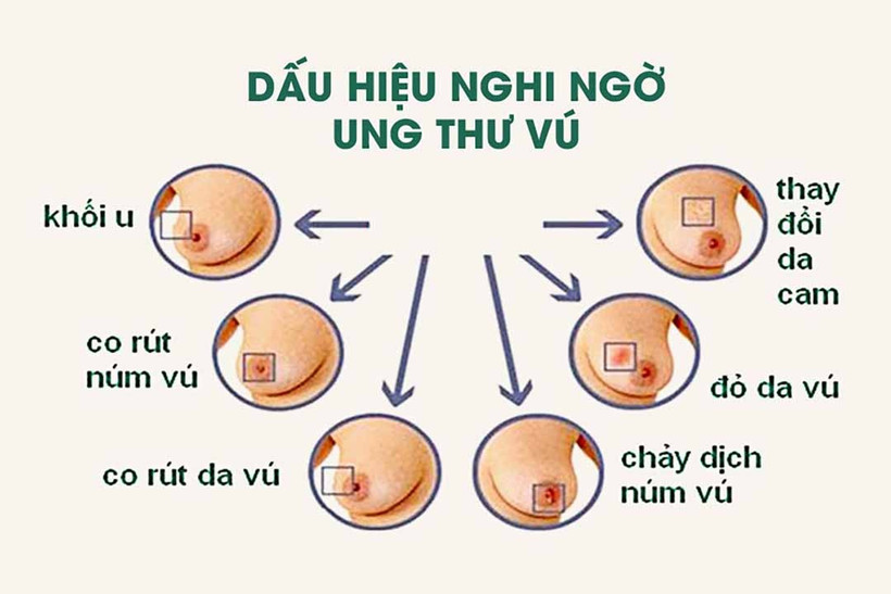 Ung thư vú là nguyên nhân gây tử vong hàng đầu do ung thư ở phụ nữ với 1,7 triệu người mắc và nửa triệu người chết hàng năm. Ảnh :benhvien108.vn 