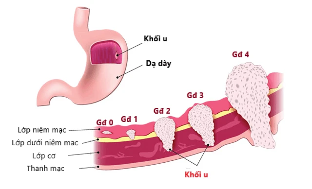 Ung thư dạ dày có thể chữa khỏi nếu phát hiện sớm
