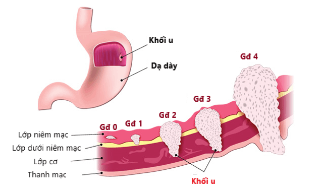 Ung thư dạ dày có thể chữa khỏi nếu phát hiện sớm