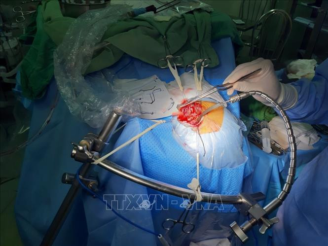 Các bác sĩ can thiệp kẹp cổ túi phình, cứu sống bệnh nhân. Ảnh: TTXVN phát