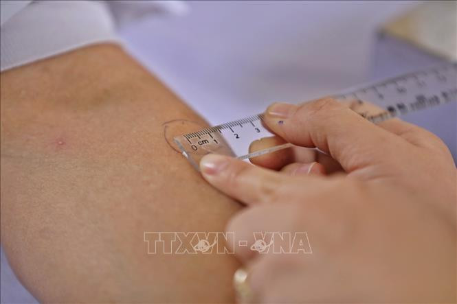 Kỹ thuật viên thực hiện tiêm TST để chẩn đoán nhiễm lao cho người tiếp xúc với ca bệnh lao. Ảnh: Minh Quyết – TTXVN 