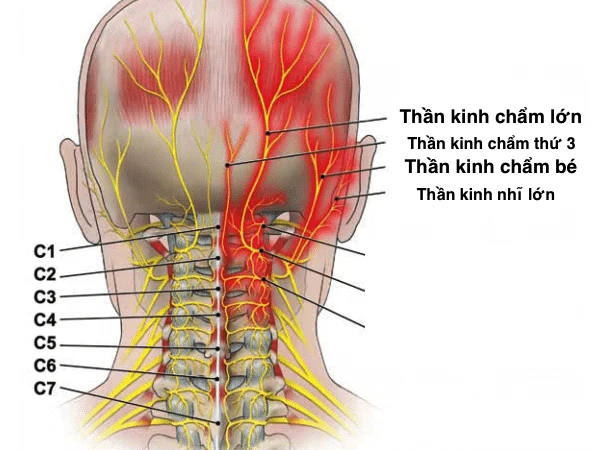 Đau dây thần kinh chẩm là một nguyên nhân phổ biến gây đau đầu. Ảnh : vinmec.com 