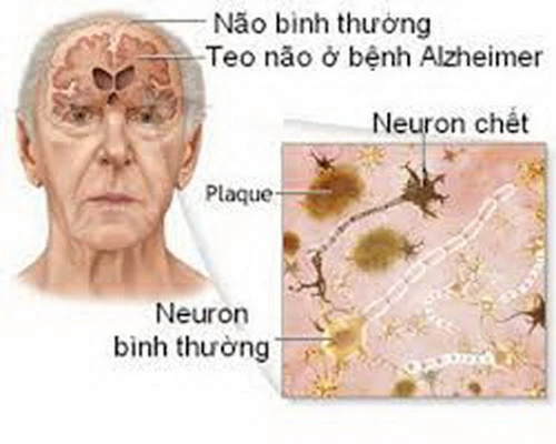 Alzheimer là bệnh mất trí nhớ dần dần, hay xuất hiện ở người lớn tuổi. Ảnh : suckhoedoisong.vn 