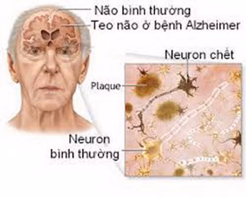 Alzheimer là bệnh mất trí nhớ dần dần, hay xuất hiện ở người lớn tuổi. Ảnh : suckhoedoisong.vn 