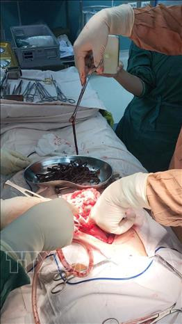 Các bác sỹ phẫu thuật lấy ra các dị vật kim loại từ dạ dày của bệnh nhân. Ảnh: TTXVN phát Bệnh viện Quân y 175 phẫu thuật, lấy ra khoảng 1 kg kim loại trong bụng một bệnh nhân ảnh 2