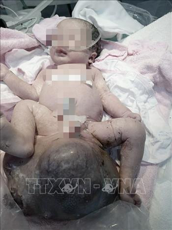 Bé sơ sinh chào đời với khối u quái khổng lồ vùng cùng cụt. Ảnh: TTXVN phát Thành phố Hồ Chí Minh: Phối hợp sản - nhi phẫu thuật thành công bướu quái khổng lồ ở trẻ sơ sinh ảnh 2