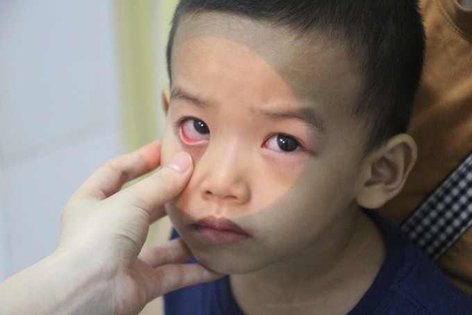 Đa số trẻ đến bệnh viện khám điều trị do được phát hiện bệnh sớm nên quá trình điều trị đều diễn ra an toàn, hiệu quả tốt. Ảnh: Bích Huệ - TTXVN Nghệ An: Thời tiết giao mùa, gia tăng nhiều dịch bệnh ảnh 1