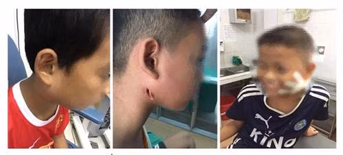 3 trường hợp mắc chứng bệnh Melioidosis (hay còn gọi là Whitmore) điều trị tại Bệnh viện Sản Nhi Nghệ An. Ảnh: 24h.com.vn 3 trường hợp mắc chứng bệnh Melioidosis (hay còn gọi là Whitmore) điều trị tại Bệnh viện Sản Nhi Nghệ An. Ảnh: 24h.com.vn