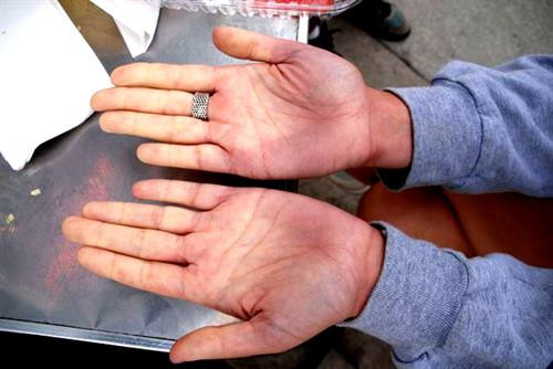 Khi mắc chứng bệnh Raynaud, người bệnh cảm thấy đau đớn, ngứa và tê ở vùng da mất màu, tái lạnh từng mảng, tím, lan nhanh ở cả hai bàn tay và chân. Khi mắc chứng bệnh Raynaud, người bệnh cảm thấy đau đớn, ngứa và tê ở vùng da mất màu, tái lạnh từng mảng, tím, lan nhanh ở cả hai bàn tay và chân.