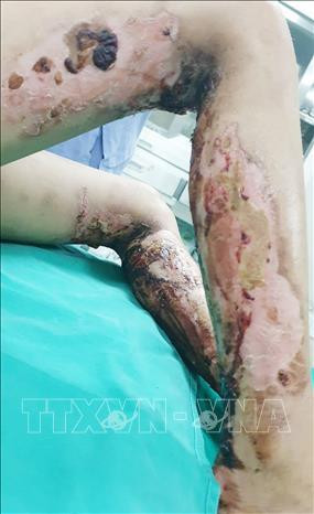 Vết thương bị bỏng nặng của bệnh nhân ở cả hai chân. Ảnh: Trung Kiên - TTXVN Vết thương bị bỏng nặng của bệnh nhân ở cả hai chân. Ảnh: Trung Kiên - TTXVN