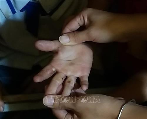 Nhiều học sinh bị ngứa, lở tay chân chưa rõ nguyên nhân. Ảnh: TTXVN Nhiều học sinh bị ngứa, lở tay chân chưa rõ nguyên nhân. Ảnh: TTXVN