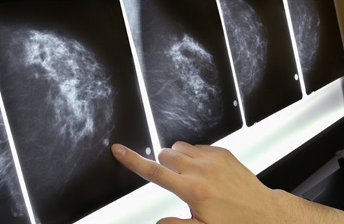 Chẩn đoán ung thư vú chỉ trong 10 phút ảnh 1
