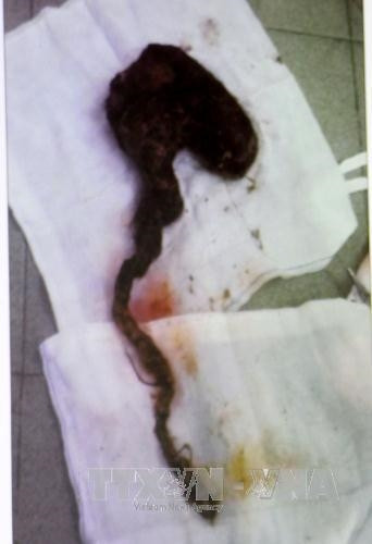 Búi tóc trong dạ dày bệnh nhi P.P.T được lấy ra. Ảnh: Phương Vy - TTXVN Búi tóc trong dạ dày bệnh nhi P.P.T được lấy ra. Ảnh: Phương Vy - TTXVN