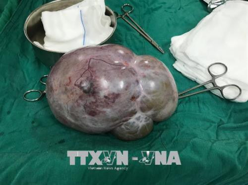 Khối u nặng 4kg trên người phụ nữ 63 tuổi. Ảnh: Quang Thái- TTXVN Khối u nặng 4kg trên người phụ nữ 63 tuổi. Ảnh: Quang Thái- TTXVN