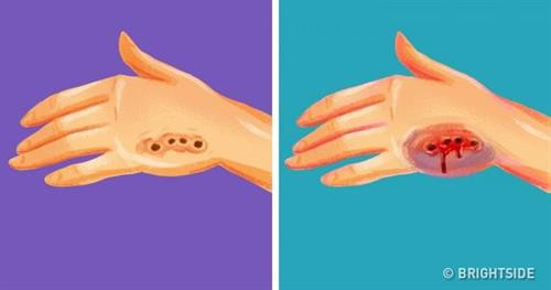 Dù bị con gì cắn, thì việc đầu tiên bạn cần làm là rửa sạch vết thương bằng nước ấm và xà phòng diệt khuẩn. Hãy nhớ, miệng của các loài động vật là một ổ vi khuẩn. Chúng sẽ khiến bạn có nguy cơ nhiễm trùng cực kỳ cao. Trong trường hợp thấy vết thương chảy máu rất lâu, sau đó sưng tấy đỏ thì hãy cẩn thận. Có thể sinh vật vừa cắn bạn đã mắc phải bệnh dại. Nếu như sau đó bạn bị sốt, vết thương thì ngứa điên đảo, khả năng ấy là trên 90%. Bệnh dại có thể gây chết người trong vòng 4 - 7 ngày, nên bạn sẽ phải đến bệnh viện để tiêm vaccine trong vòng 1 - 3 ngày kể từ khi bị cắn. Dù bị con gì cắn, thì việc đầu tiên bạn cần làm là rửa sạch vết thương bằng nước ấm và xà phòng diệt khuẩn. Hãy nhớ, miệng của các loài động vật là một ổ vi khuẩn. Chúng sẽ khiến bạn có nguy cơ nhiễm trùng cực kỳ cao. Trong trường hợp thấy vết thương chảy máu rất lâu, sau đó sưng tấy đỏ thì hãy cẩn thận. Có thể sinh vật vừa cắn bạn đã mắc phải bệnh dại. Nếu như sau đó bạn bị sốt, vết thương thì ngứa điên đảo, khả năng ấy là trên 90%. Bệnh dại có thể gây chết người trong vòng 4 - 7 ngày, nên bạn sẽ phải đến bệnh viện để tiêm vaccine trong vòng 1 - 3 ngày kể từ khi bị cắn.