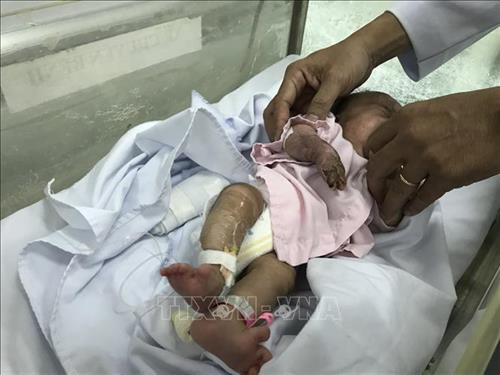 Bệnh nhi vẫn đang được tiếp tục theo dõi, điều trị tại Bệnh viện Nhi đồng 1. Ảnh: Đinh Hằng - TTXVN