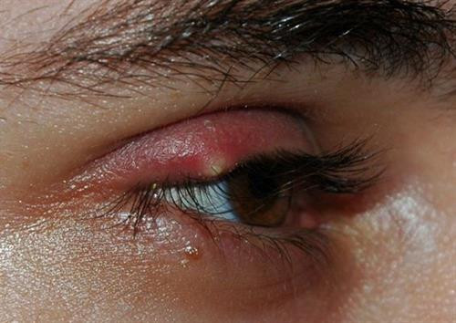 Mụn lẹo gây ảnh hưởng tới thẩm mỹ và tầm nhìn của người bệnh.