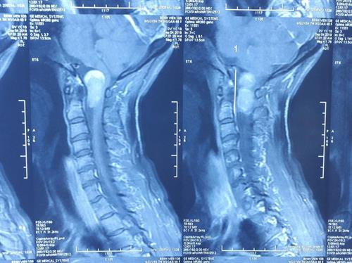 Phim chụp Xquang ảnh khối u vùng chẩm cổ của bệnh nhân. Ảnh : baomoi.com Phim chụp Xquang ảnh khối u vùng chẩm cổ của bệnh nhân. Ảnh : baomoi.com