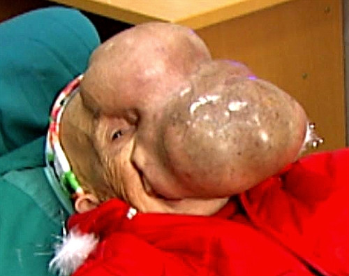 khối u khổng lồ nặng 3 kg trên mặt cho bệnh nhân Triều Mù Chài trước khi được phẫu thuật. Ảnh tư liệu của Viện Răng - Hàm - Mặt Trung ương