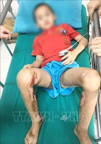 Vết thương bị bỏng nặng của bệnh nhân ở cả hai chân. Ảnh: Trung Kiên - TTXVN Vết thương bị bỏng nặng của bệnh nhân ở cả hai chân. Ảnh: Trung Kiên - TTXVN