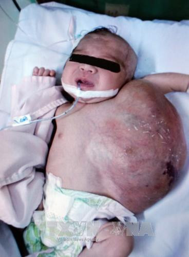 Bệnh nhi có khối bướu khổng lồ trước khi phẫu thuật. Ảnh: Phương Vy-TTXVN