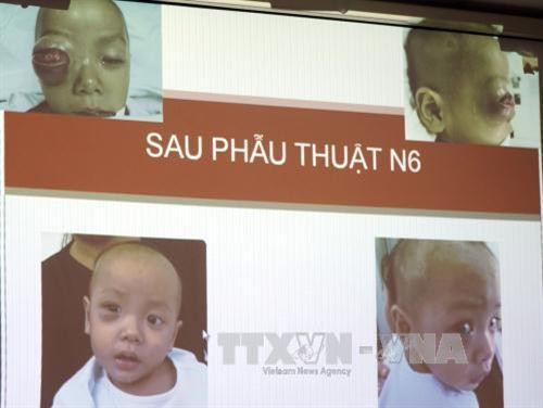 Hình ảnh bé trai 16 tháng tuổi trước và sau khi phẫu thuật biến chứng ổ mắt do viêm xoang. Ảnh: Phương Vy - TTXVN